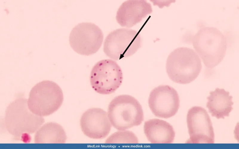 Basophilic stippling in lead poisoning