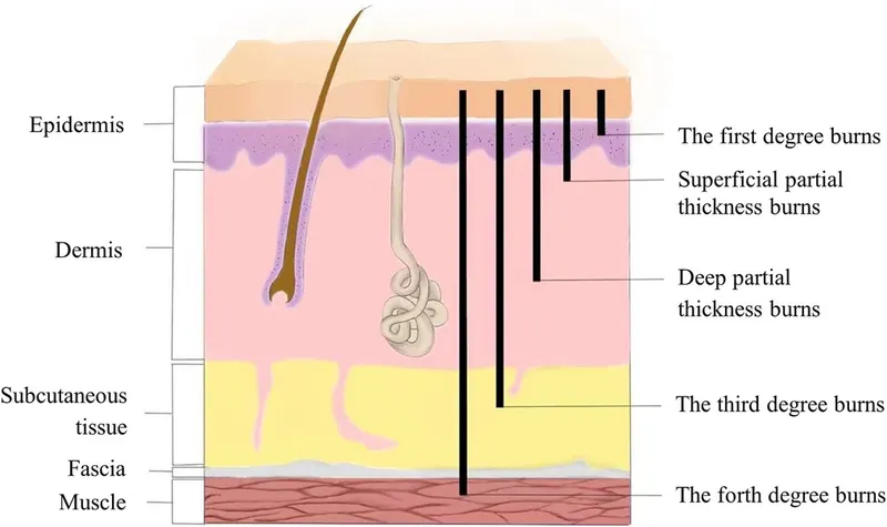 Burn depth by skin layer: 1st, 2nd, 3rd, and 4th degree