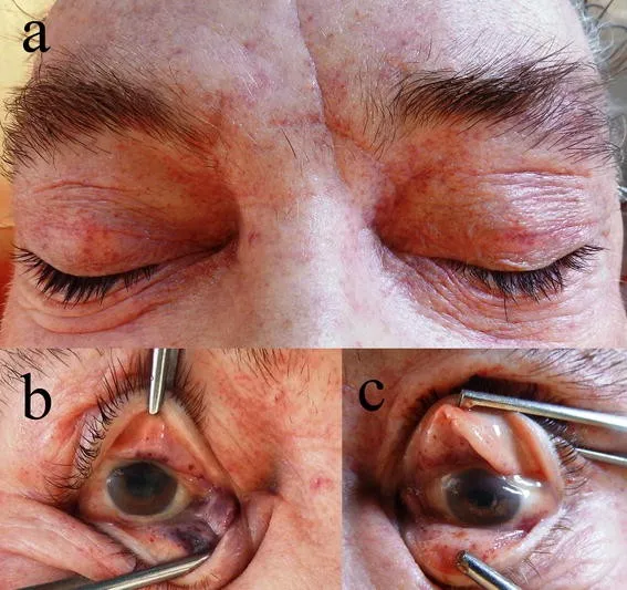 Petechial hemorrhages of conjunctiva in asphyxia