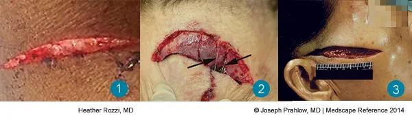 Laceration vs. Incised Wound: Tissue Bridging