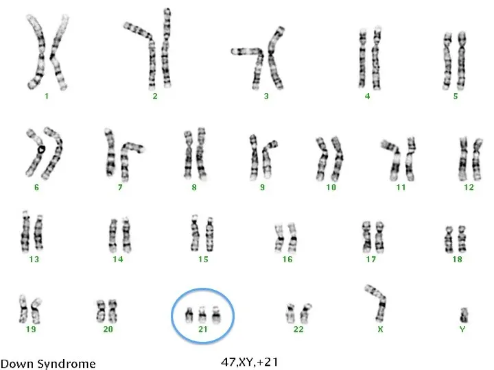 Karyotype showing trisomy 21 (Down syndrome)