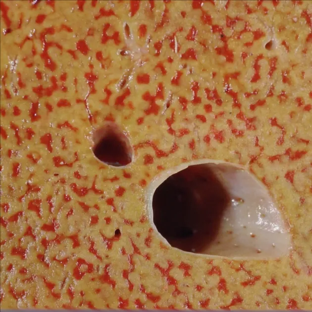 Nutmeg liver gross appearance