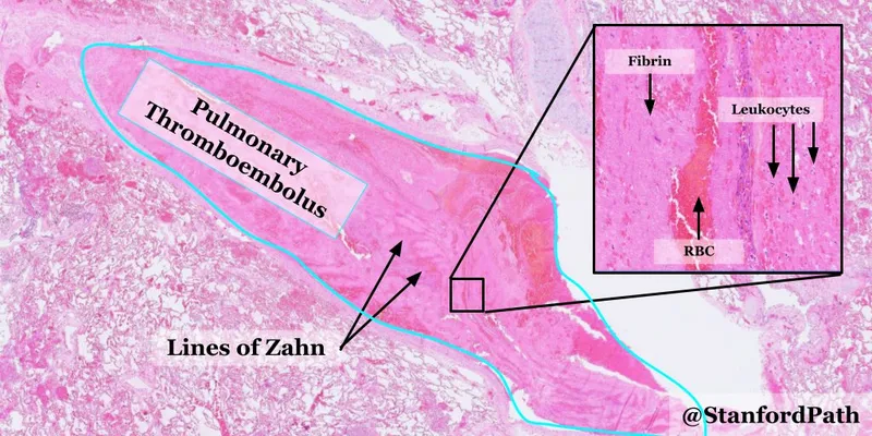 Pulmonary Thromboembolus with Lines of Zahn