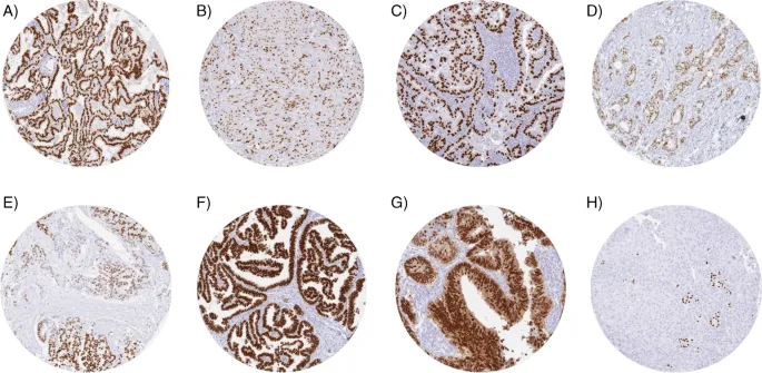 TTF-1 IHC in lung adenocarcinoma and other tumors