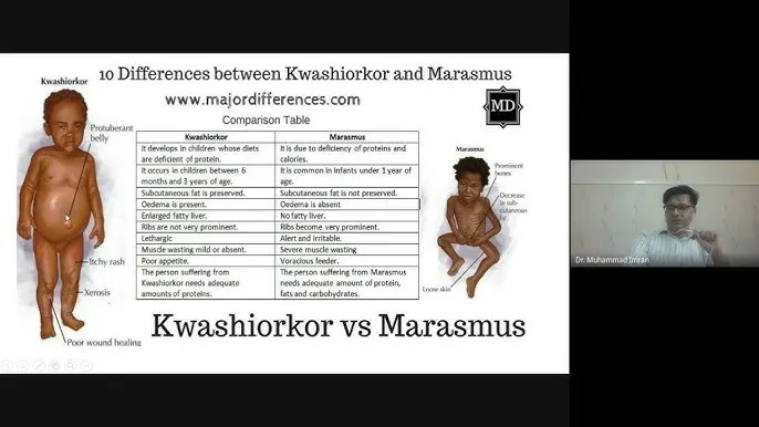 Kwashiorkor vs Marasmus Comparison