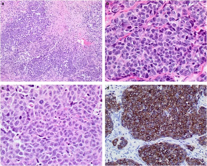 Histology of small round blue cell tumors