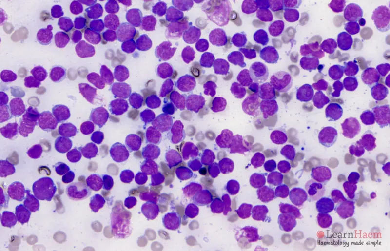 Peripheral blood smear showing lymphoblasts in ALL