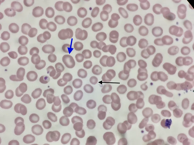 Peripheral smear showing different red blood cell sizes