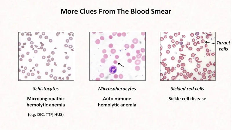 Peripheral smear findings in different types of anemia