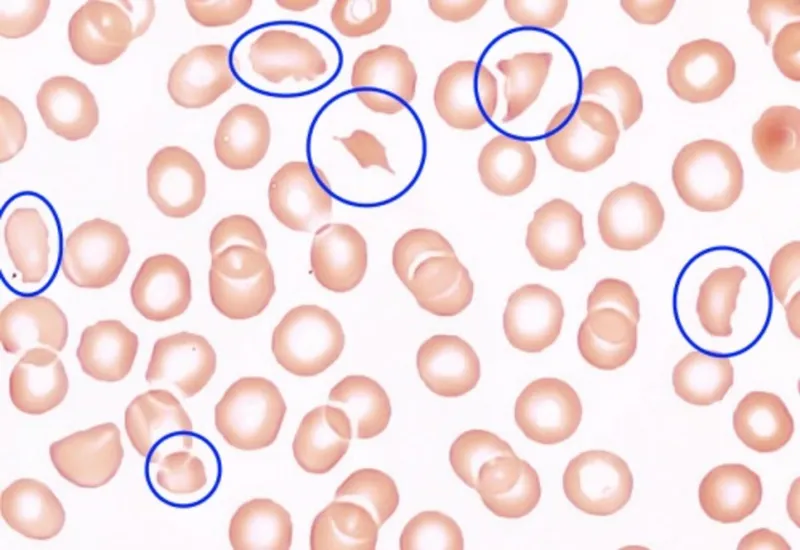 Peripheral blood smear: TTP with schistocytes
