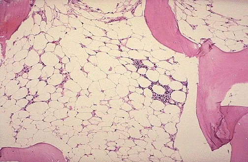 Aplastic Anemia Bone Marrow Biopsy: Hypocellularity & Fat
