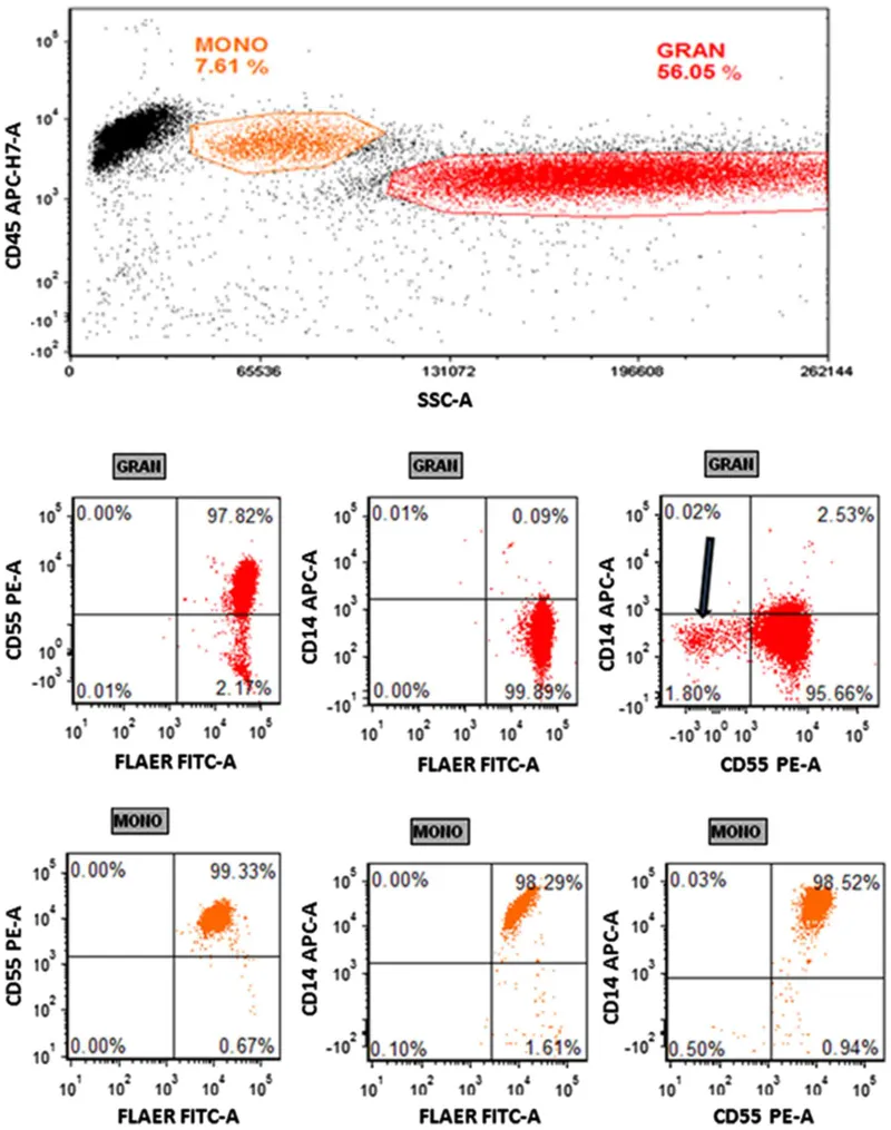 PNH flow cytometry: CD55/CD59 negative granulocytes