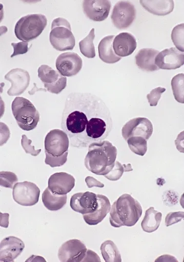 Pseudo-Pelger-Huët anomaly in myelodysplastic syndrome