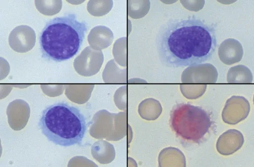 Hairy cell leukemia with TRAP stain