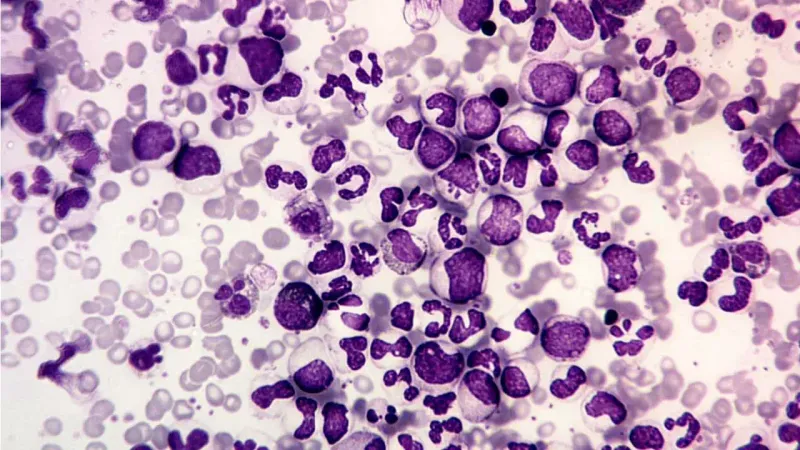 CML peripheral blood smear with myeloid cells and basophilia