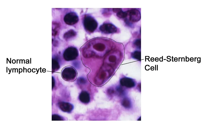 Reed-Sternberg Cell and Normal Lymphocyte