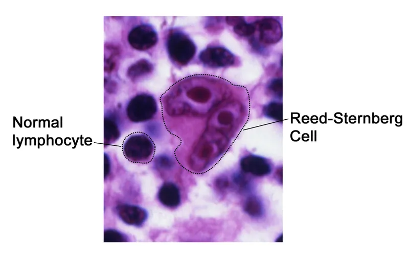 Reed-Sternberg cell with "owl-eye" appearance