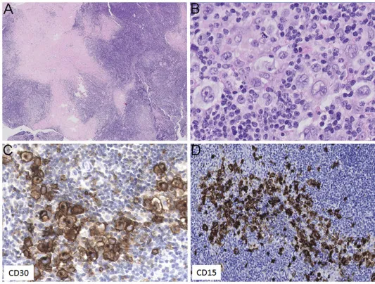 Nodular Sclerosis Hodgkin Lymphoma Histopathology