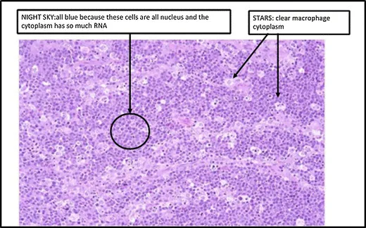 Burkitt Lymphoma: Starry Sky Histology