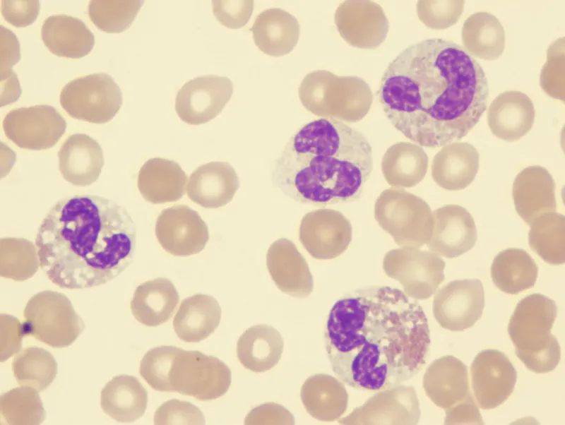 Dysplastic neutrophils in Myelodysplastic Syndrome