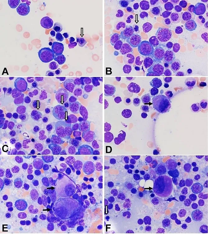 MDS: Dysplastic megakaryocytes and erythroid precursors