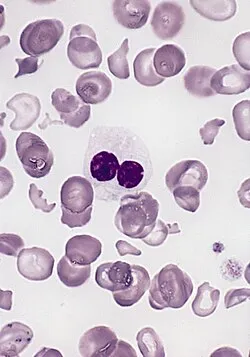 Pseudo-Pelger-Huët neutrophil and dyserythropoiesis in MDS
