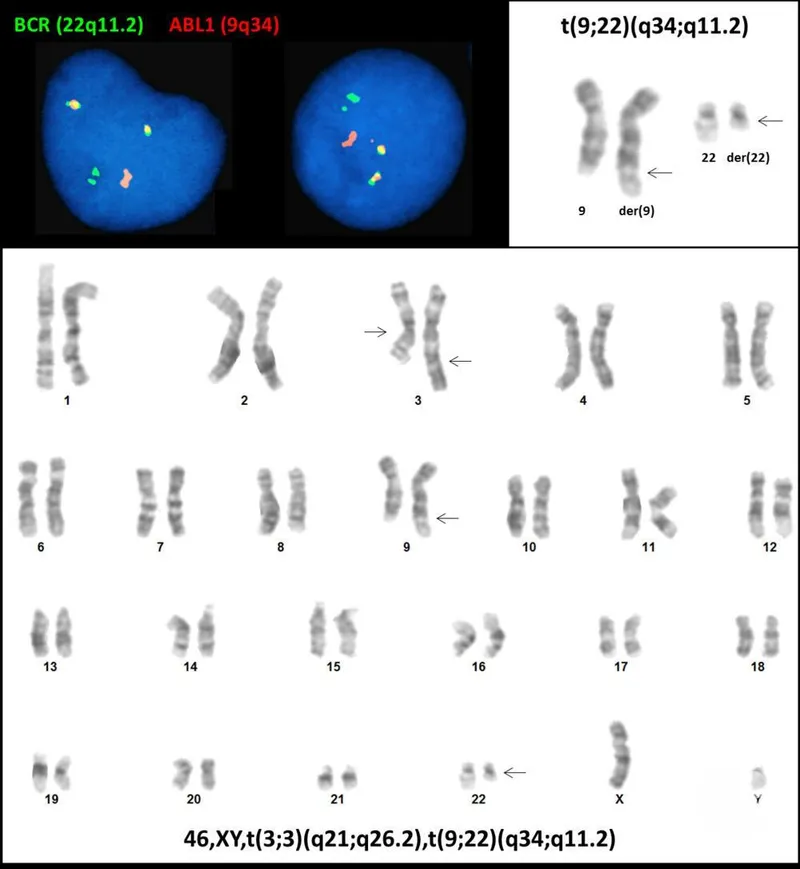 CML Karyotype with t(9;22) and FISH