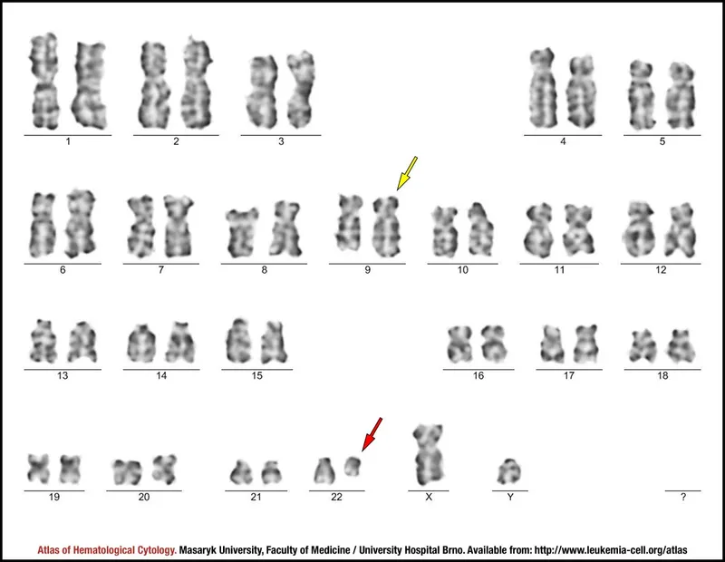 Karyotype with Philadelphia Chromosome t(9;22)