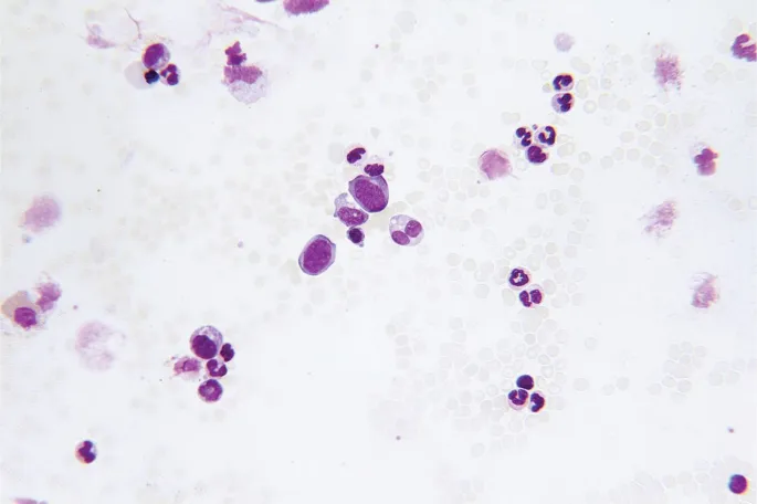 Peripheral blood smear in myeloproliferative neoplasm