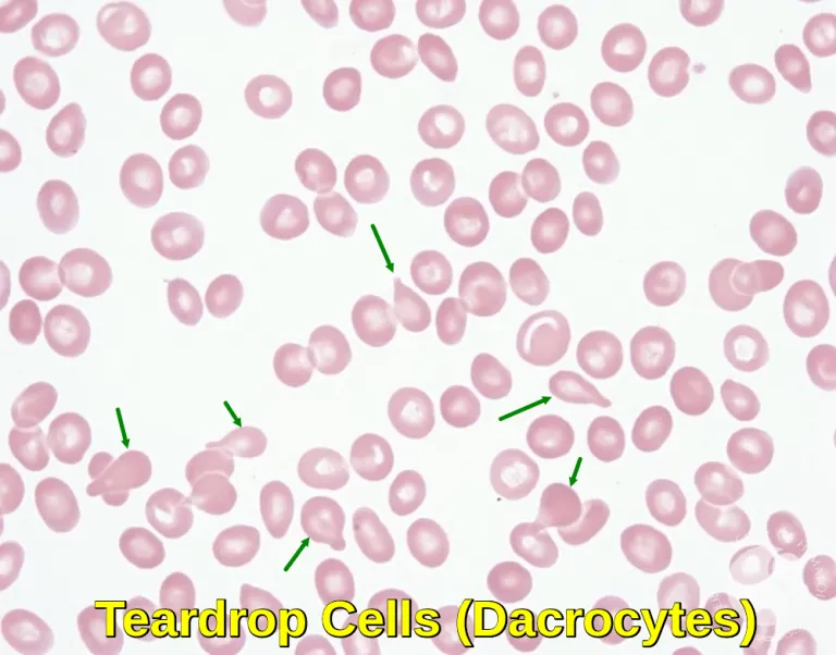 Peripheral smear showing dacrocytes (teardrop cells)