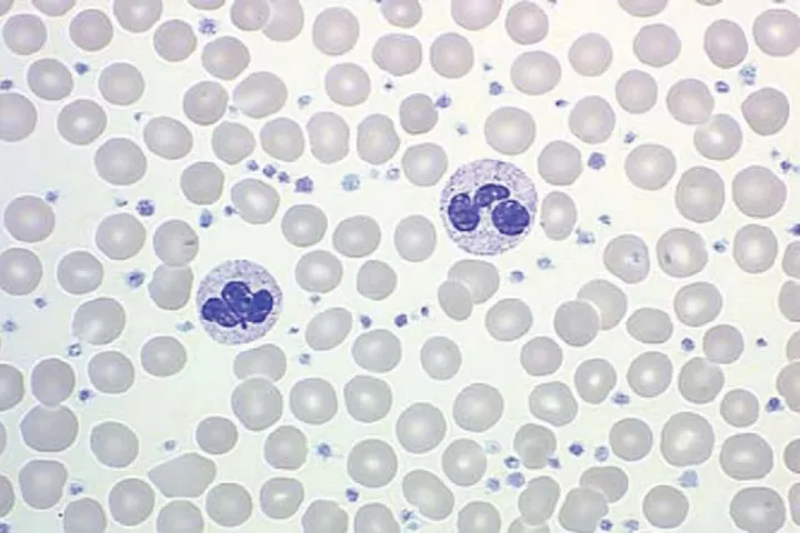 Polycythemia Vera peripheral blood smear