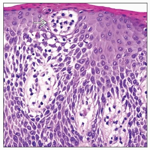 Pautrier's microabscess in Mycosis Fungoides