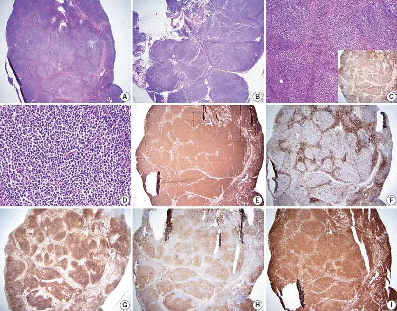 Follicular Lymphoma Histology and Immunohistochemistry