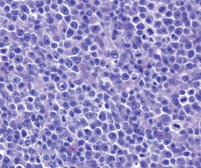 DLBCL Histopathology: Large Atypical Lymphocytes