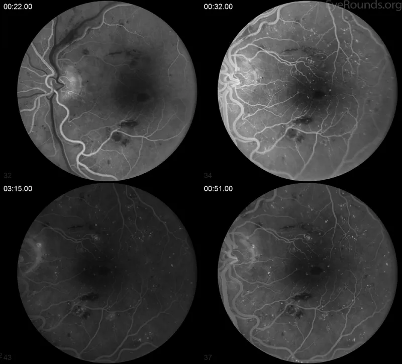Fundoscopy: Retinal Veins in Waldenstrom Macroglobulinemia