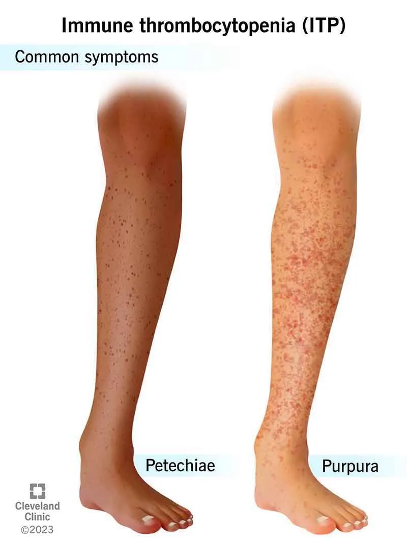 Petechiae and Purpura in Immune Thrombocytopenia (ITP)