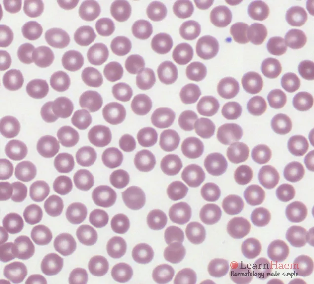 Normal red blood cells in peripheral blood smear