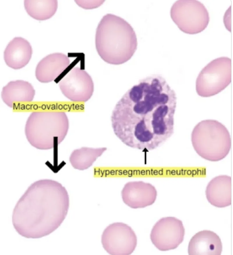 Hypersegmented neutrophil and macro-ovalocytes