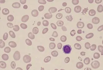 Microcytic hypochromic anemia with target cells
