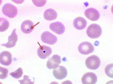 Howell-Jolly bodies in red blood cells (hyposplenism)