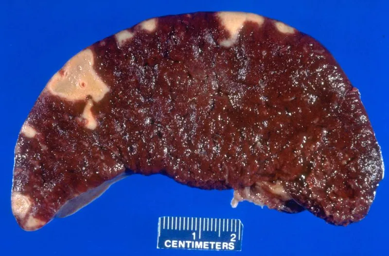 Gross pathology of splenic infarcts with ruler