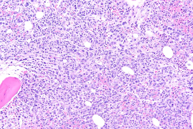Multiple Myeloma in Bone Marrow Biopsy