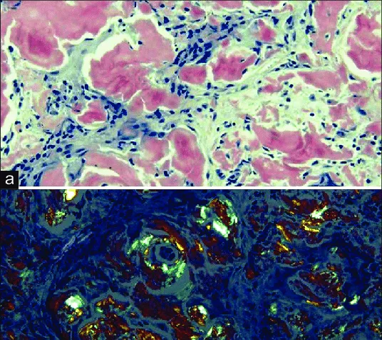 Amyloidosis: Congo Red stain with apple-green birefringence