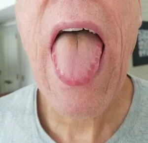 Macroglossia with tooth indentations in amyloidosis