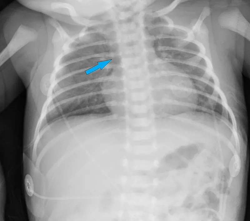 DiGeorge syndrome infant facies and chest X-ray