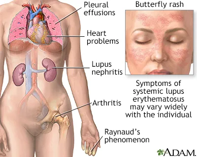 Systemic Lupus Erythematosus (SLE) Symptoms