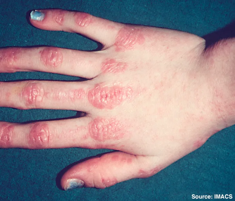 Gottron papules on hand in dermatomyositis