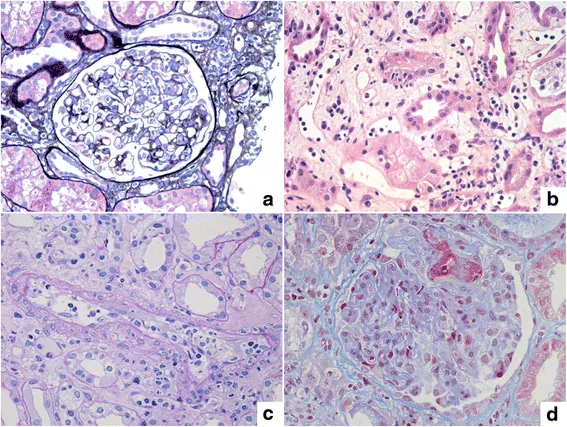 Histopathology of kidney transplant rejection