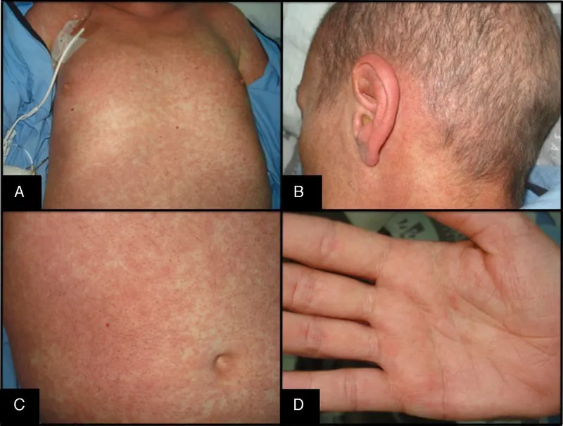 Graft-versus-host disease (GVHD) skin rash