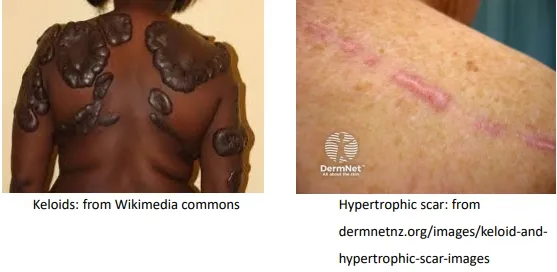Keloid vs. Hypertrophic Scar Clinical Appearance